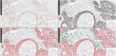 Digital Slide Assessment for Programmed Death-Ligand 1 Combined Positive Score in Head and Neck Squamous Carcinoma: Focus on Validation and Vision